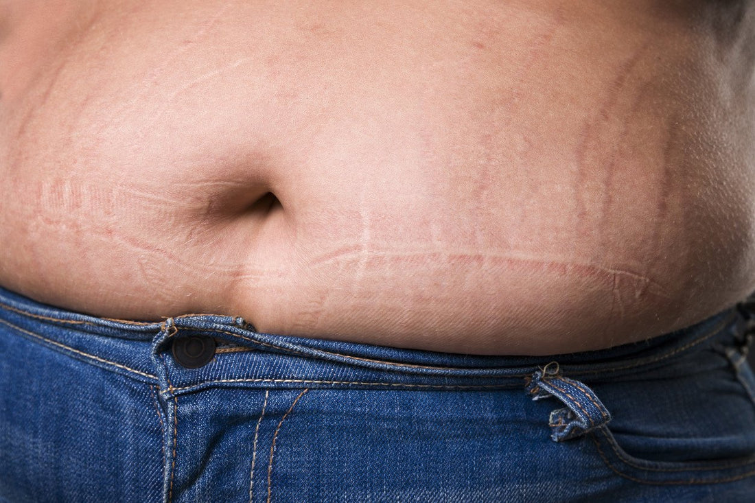 Stretch Mark Silicone Fusion Technology Reviews