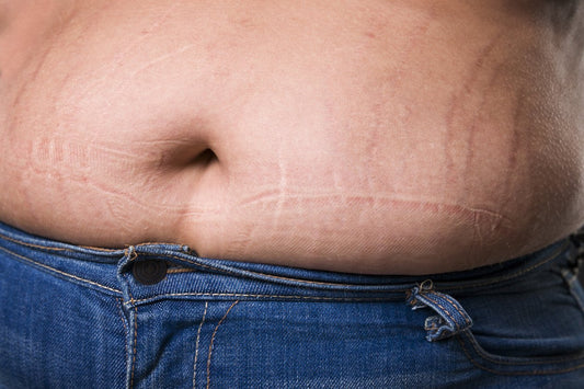 Stretch Mark Silicone Fusion Technology Reviews
