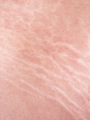 First Signs of Stretch Marks And How To Prevent Them