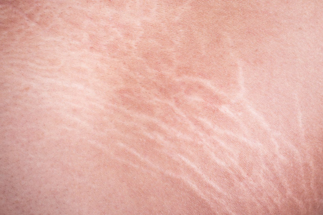 First Signs of Stretch Marks And How To Prevent Them