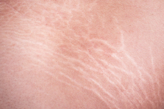 First Signs of Stretch Marks And How To Prevent Them