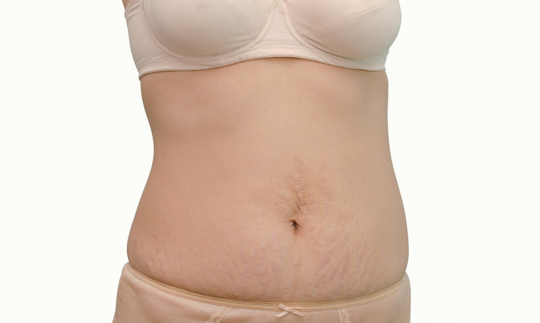 The Difference Between Red and Purple Stretch Marks