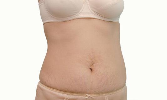 The Difference Between Red and Purple Stretch Marks