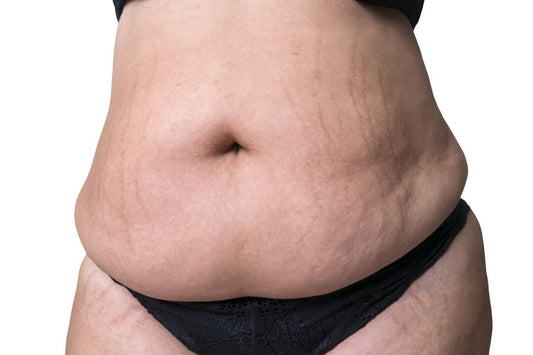 What Are Stretch Marks and Why Do We Get Them?