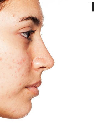 The Best Face Masks for Acne and Oily Skin