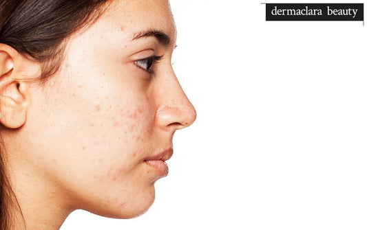The Best Face Masks for Acne and Oily Skin