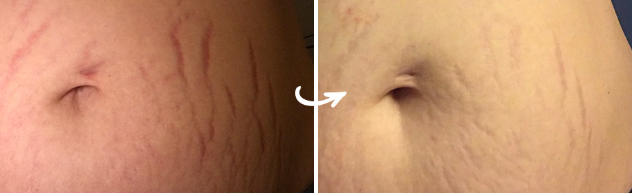 How Silicone Sheets for Stretch Marks Work