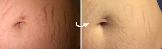 How Silicone Sheets for Stretch Marks Work