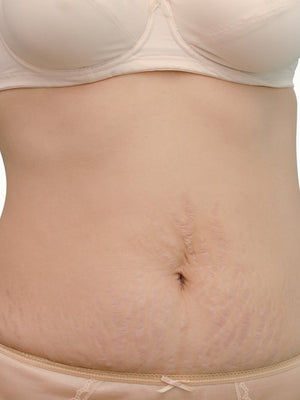 How to Repair Stretch Marks with Silicone Sheets