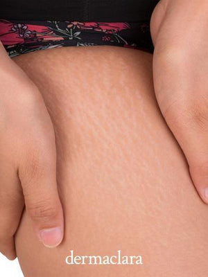 Why Teens Get Stretch Marks and How To Treat Them