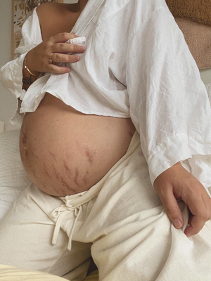 Are Stretch Marks Genetic?