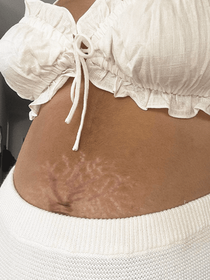 Are stretch marks scars?