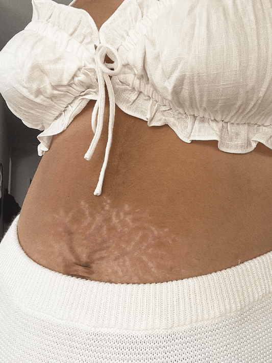 scars stretch marks