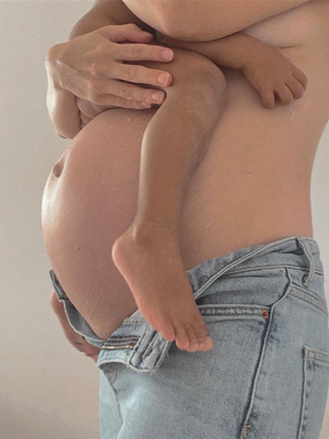 How to Prevent Stretch Marks When Having Your 2nd Child
