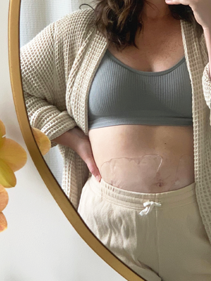 How to Prevent Stretch Marks