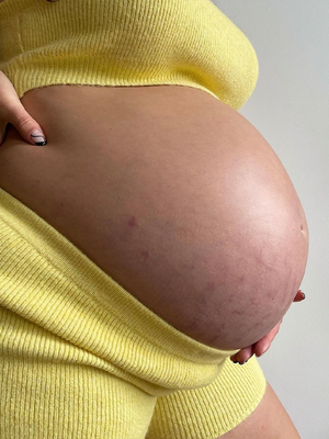 How To Get Rid Of Purple Stretch Marks For Good