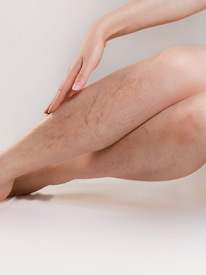 Chase Away Spider Veins with These Pro Tips