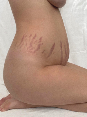 Stretch Marks: Do They Ever Really Go Away?
