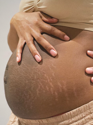 Why Are Stretch Marks Itchy?