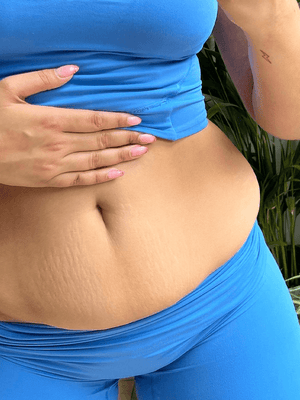 Are Gym Stretch Marks Permanent?