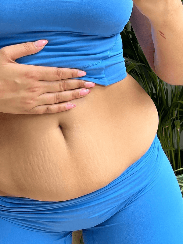 Are Gym Stretch Marks Permanent?