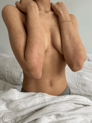 Understanding Eczema: Causes, Symptoms, and Treatments