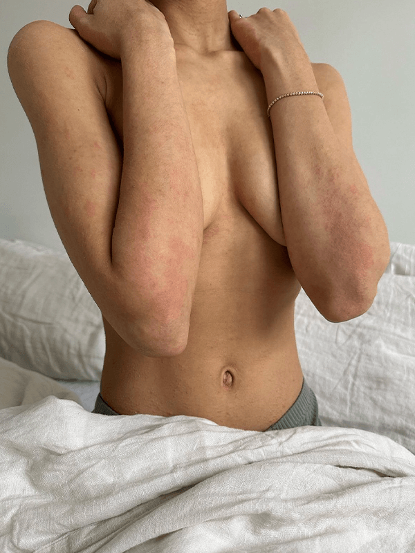 eczema