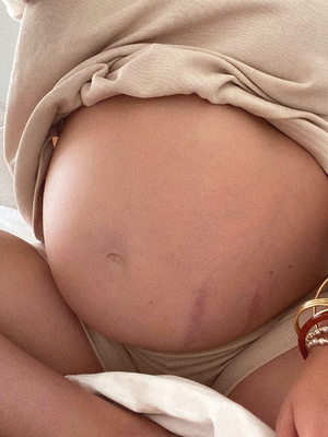 How Loose Skin Develops Over Pregnancy