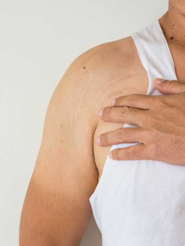 male stretch marks