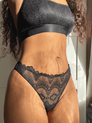 Facts about stretch marks