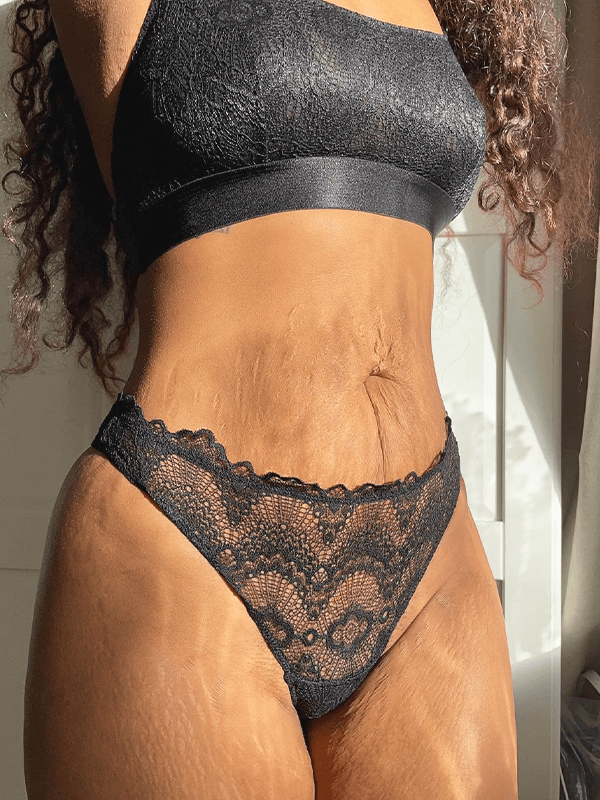scratching-stretch-marks