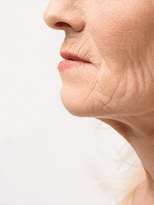 What Exactly Are Smokers Lines, and How Do They Form?