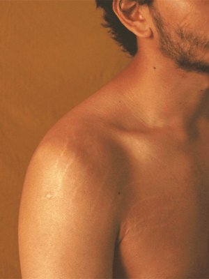 How to Remove Stretch Marks for Men