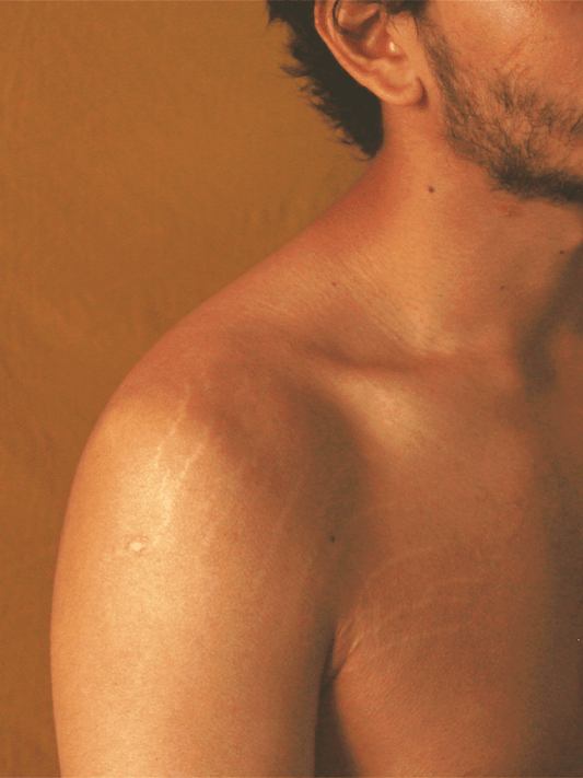 How to Remove Stretch Marks for Men