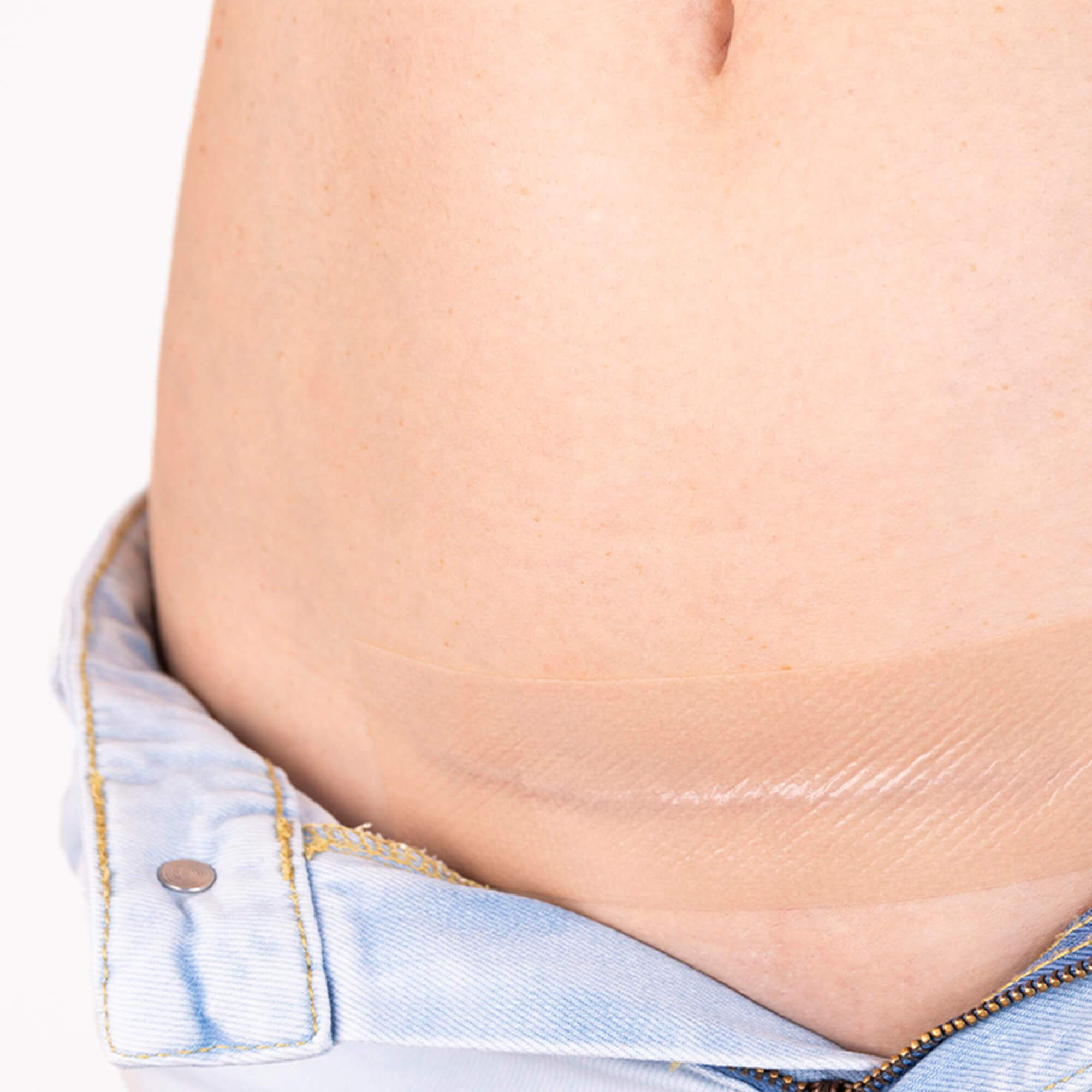Remove the patch from its backing card and place the adhesive side directly over the healed C-section scar. Make sure the scar is fully covered and smooth the patch gently against the skin.