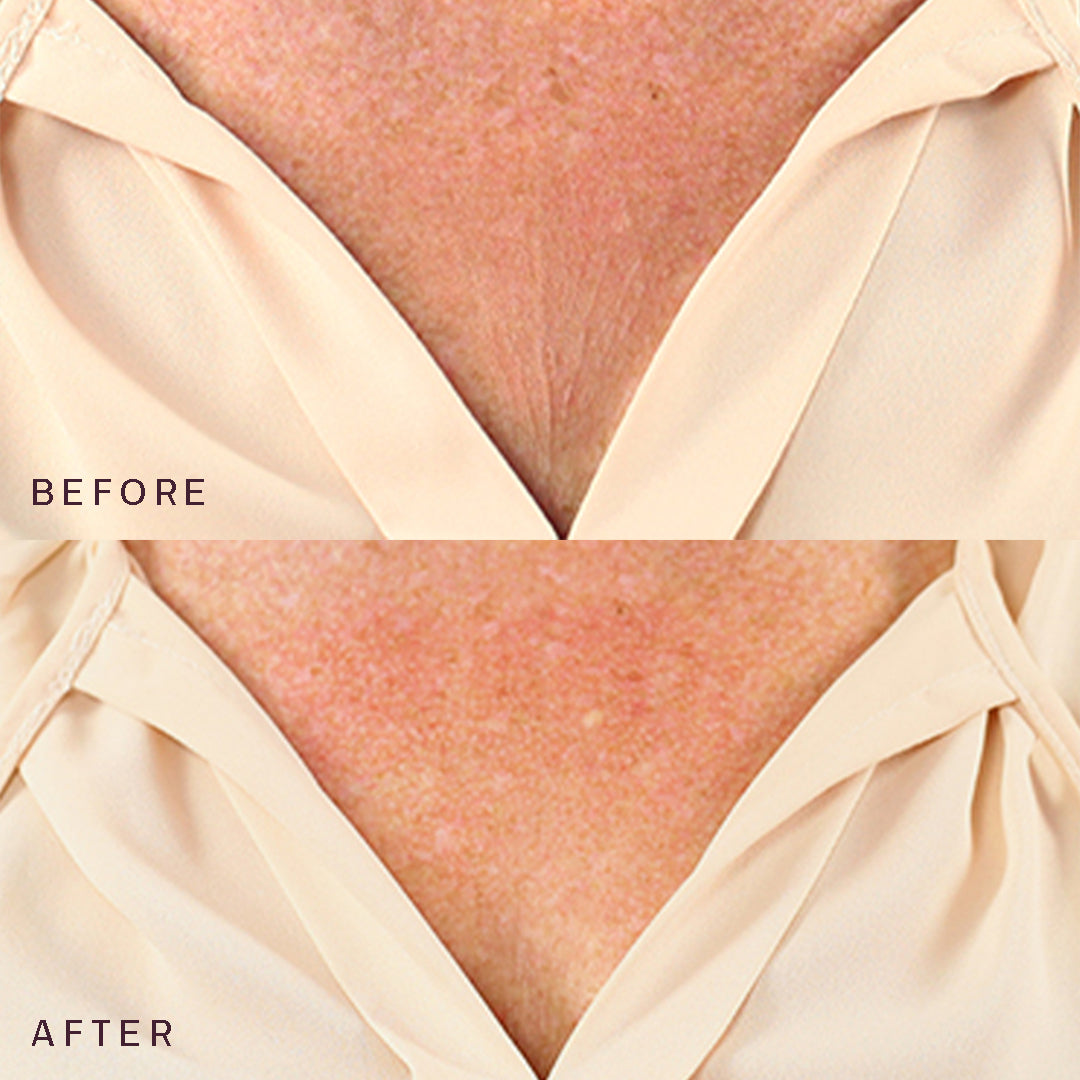 The Neck & Décolleté Occlusion Patch®