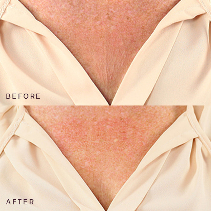 Chest & Body Occlusion Patch™