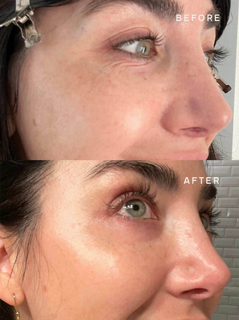 Eye-Wrinkle-Reduction-Results