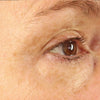 Eye_Wrinkle_After_Old