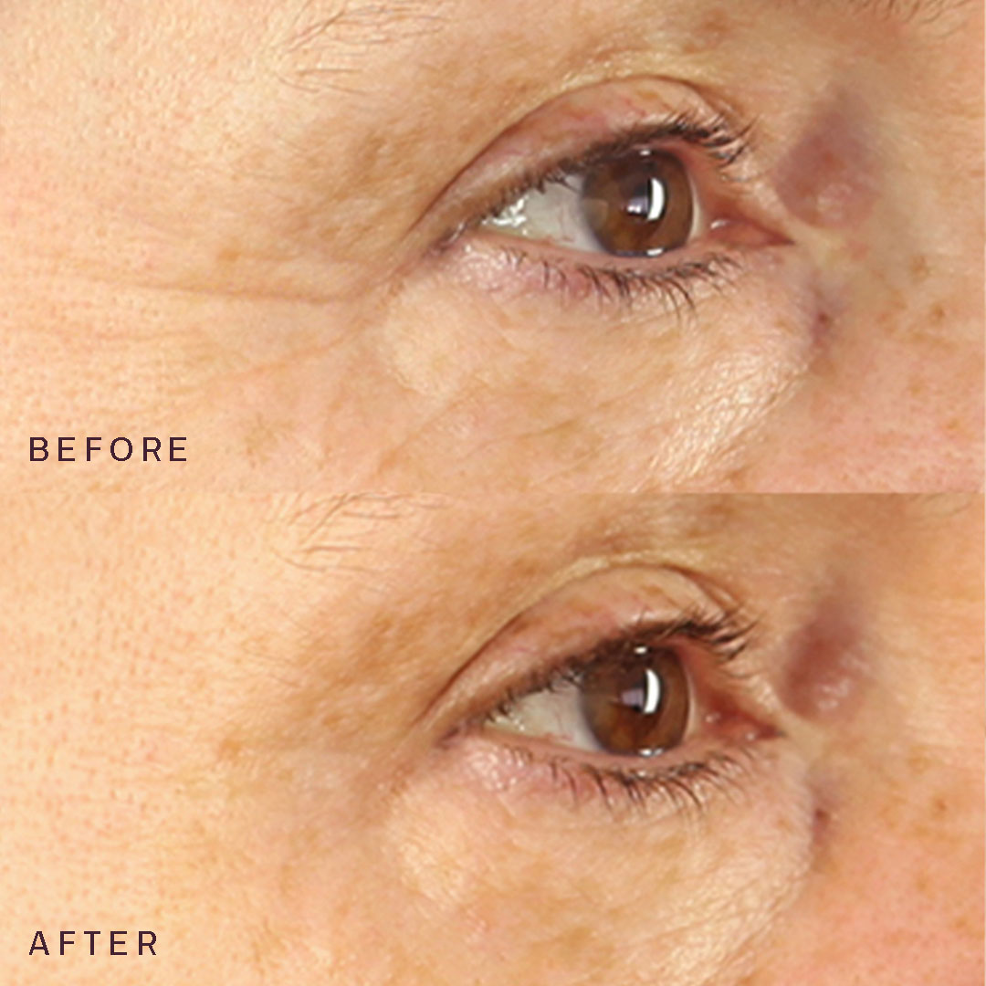 Eyes & Mouth Occlusion Patches™