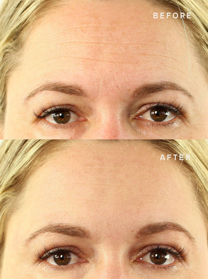 Forehead-Wrinkle-Reduction-Results