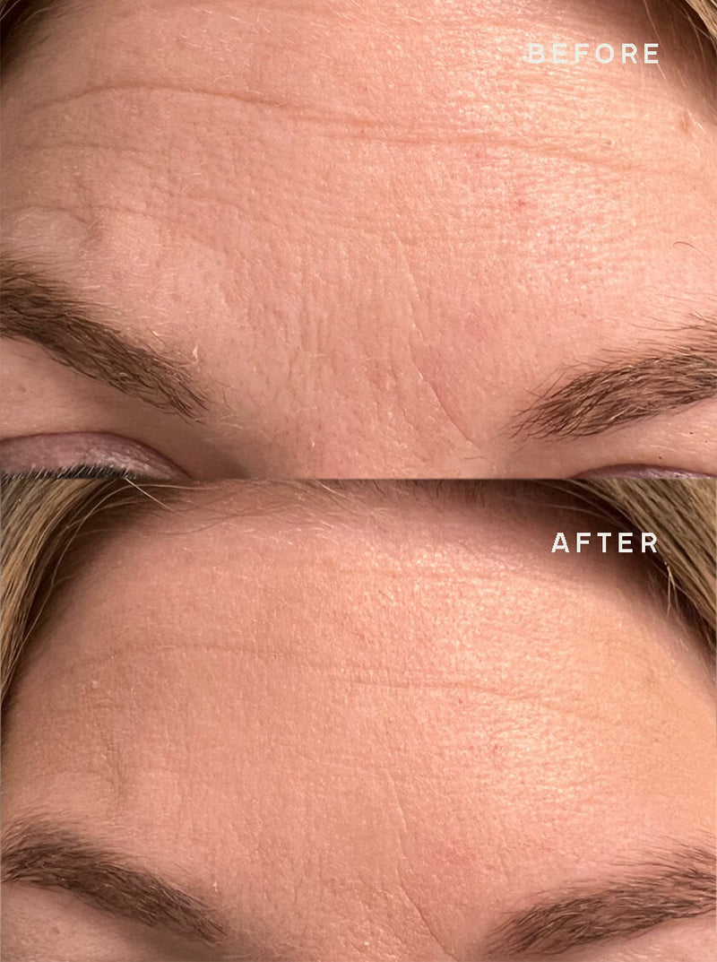 Forehead-Wrinkles-Removal-Product-Results