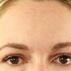 Forehead_Wrinkle_After