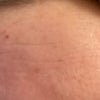 Forehead_Wrinkle_After_Closeup