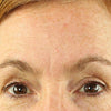 Forehead_Wrinkle_After_Old