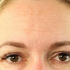 Forehead_Wrinkle_Before