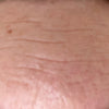 Forehead_Wrinkle_Before_Closeup
