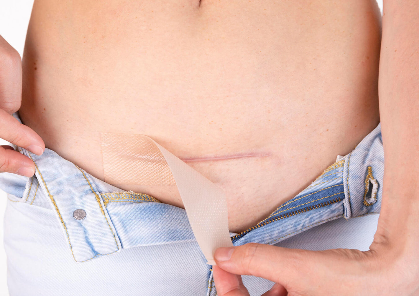 Guaranteed-C-Section-Scar-Removal