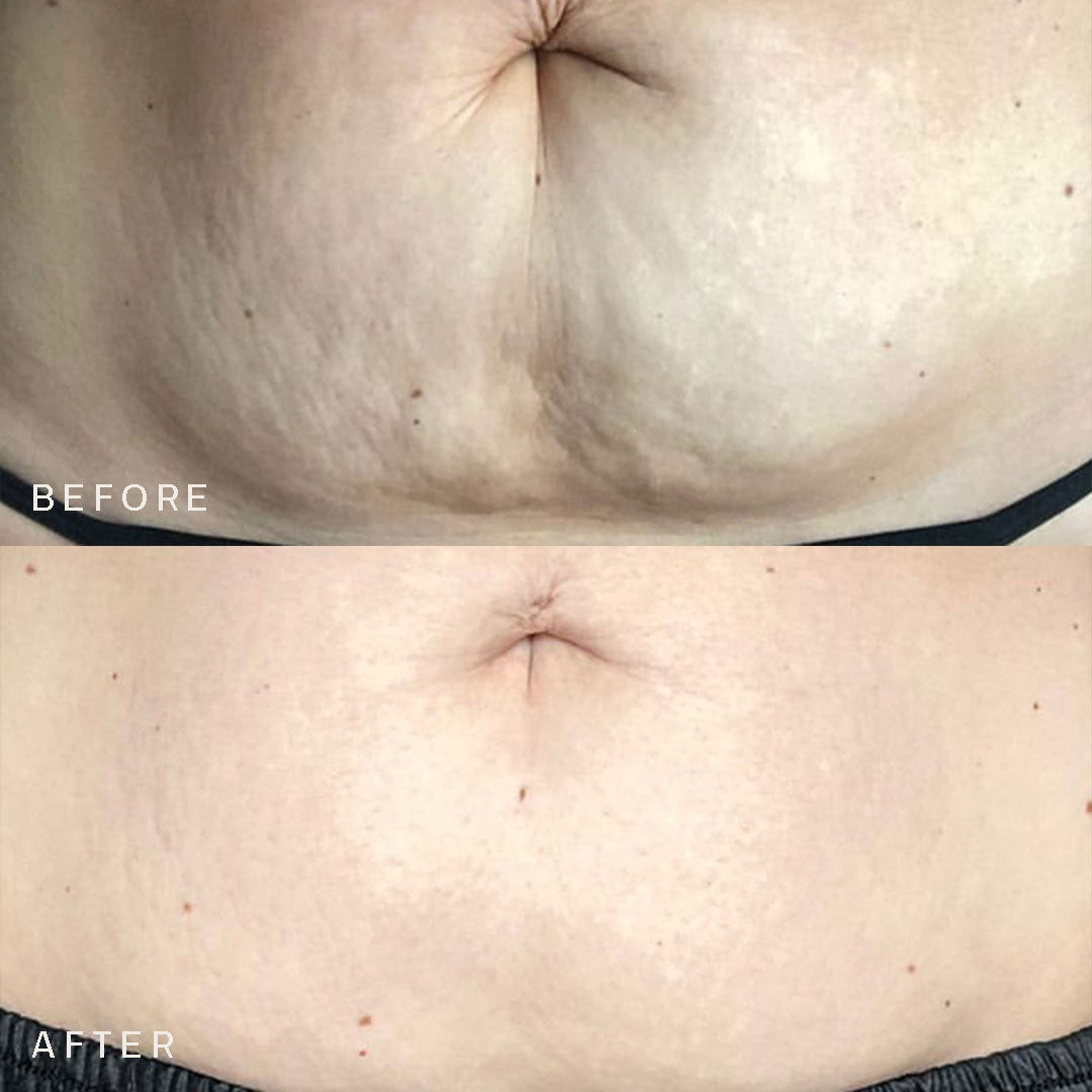 The Stretch Mark Occlusion Patch®