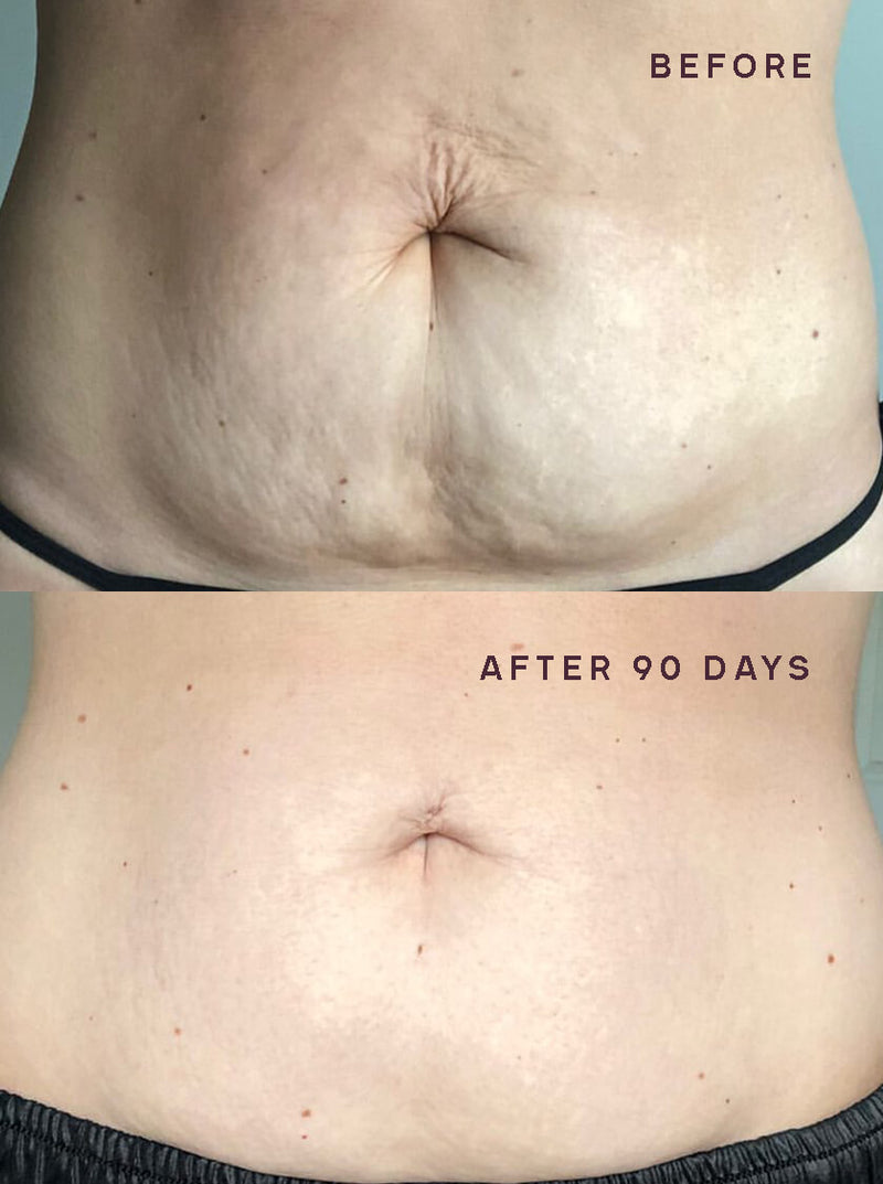 90-DAY STRETCH MARK & LOOSE SKIN RESULTS